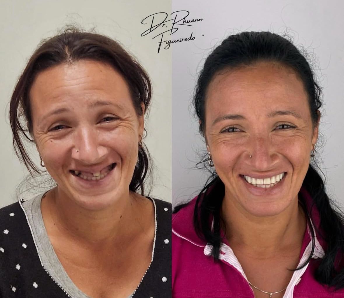 Caso de tratamento Almani