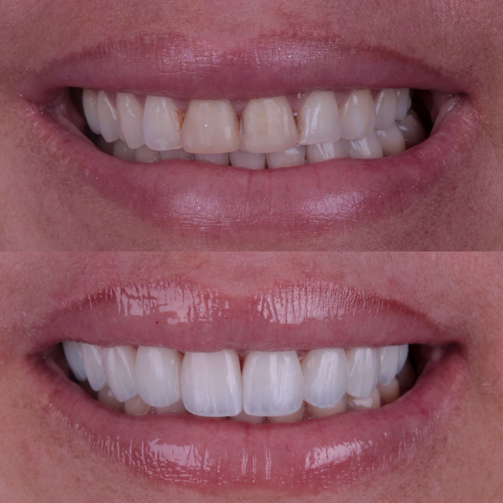 Caso de tratamento Almani